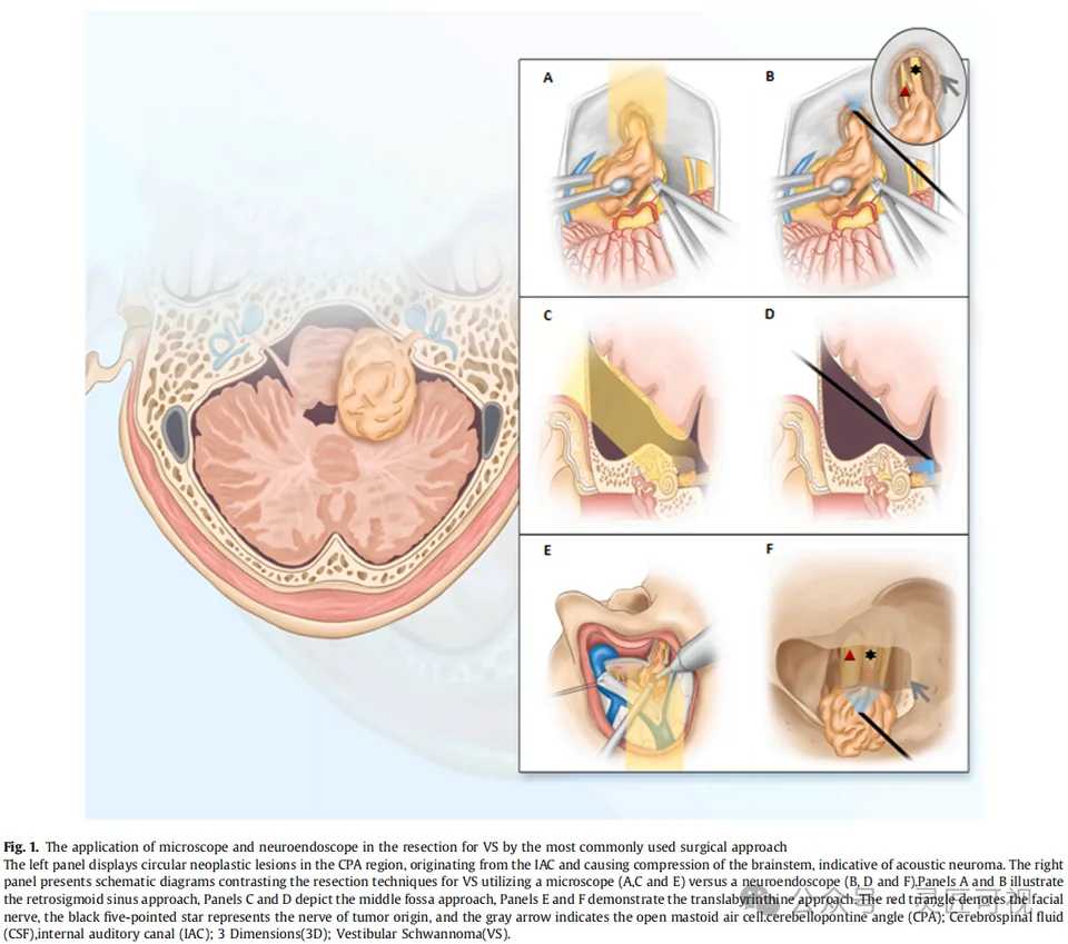 Asian Journal of Surgery 神经内镜在前庭神经鞘瘤切除中的应用科研论文示意图（作品图 2）