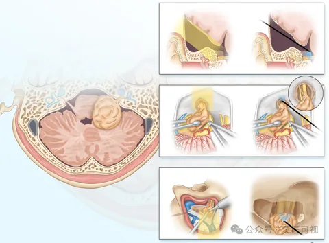 Asian Journal of Surgery 神经内镜在前庭神经鞘瘤切除中的应用科研论文示意图