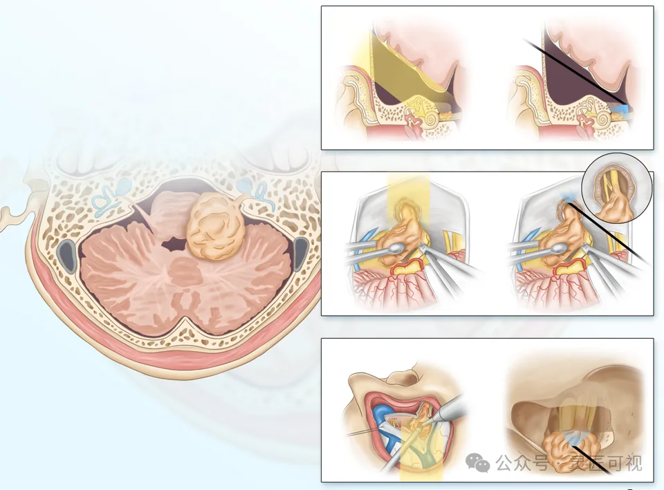 Asian Journal of Surgery 神经内镜在前庭神经鞘瘤切除中的应用科研论文示意图