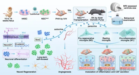 Neural Regeneration Research Sox2过表达的神经干细胞缓解出血后脑积水患者的心室扩大和神经功能障碍科研论文示意图